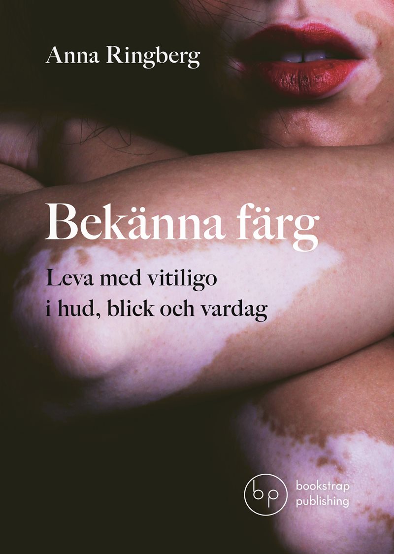 Bekänna färg: Leva med vitiligo i hud, blick och vardag